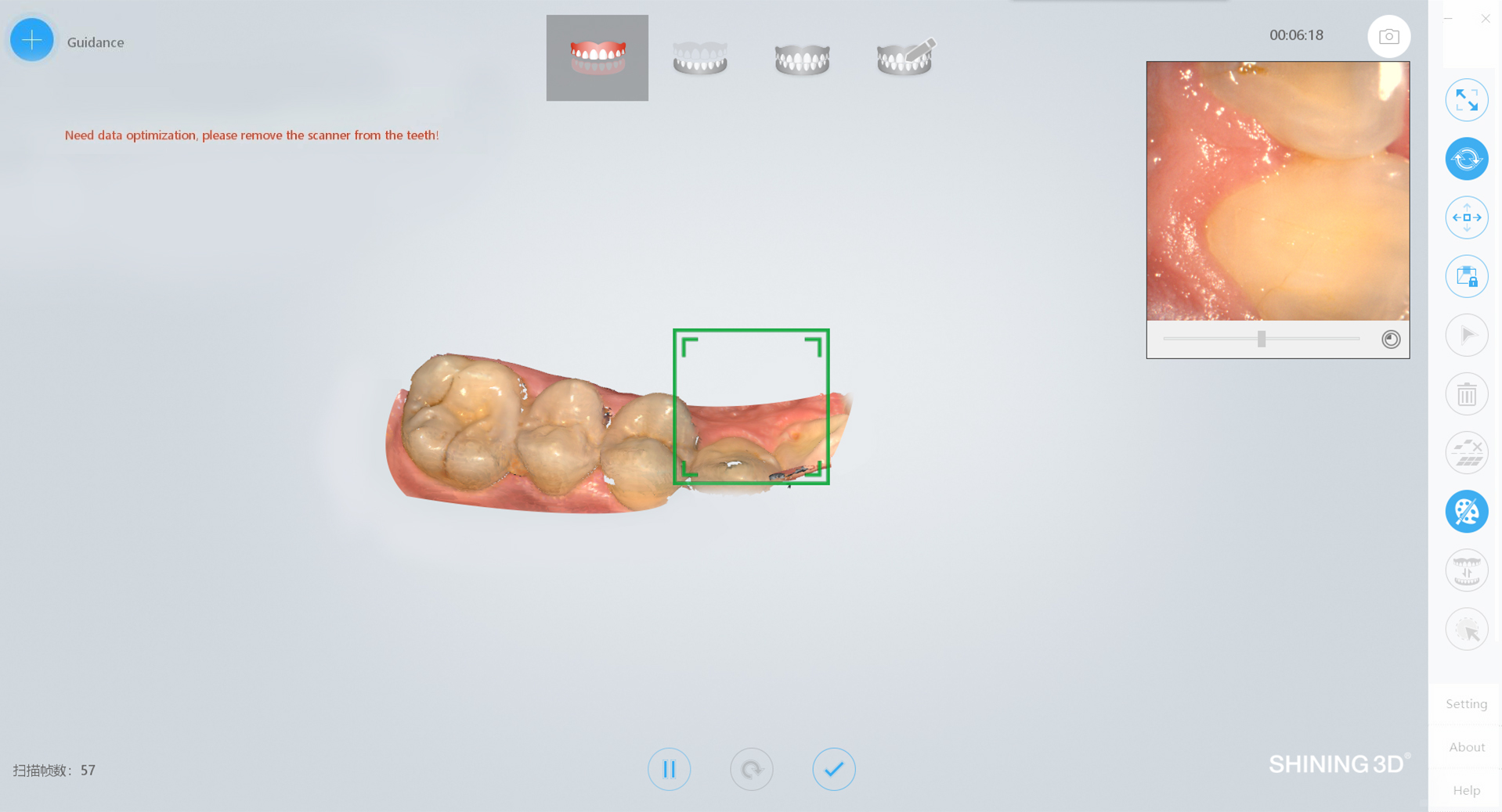 AoralScan2 Intra-oral Scan เครื่องสแกนเนอร์ในช่องปาก - Image 6