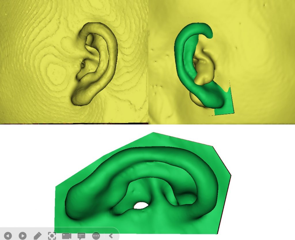 You are currently viewing 3D Scanner ใช้สำหรับภาวะใบหูเล็กไม่สมบูรณ์ (microtia)